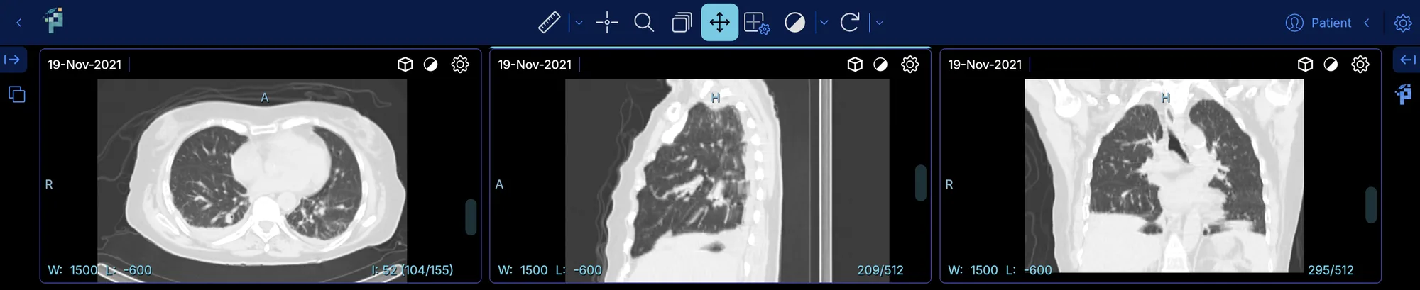 Chest CT