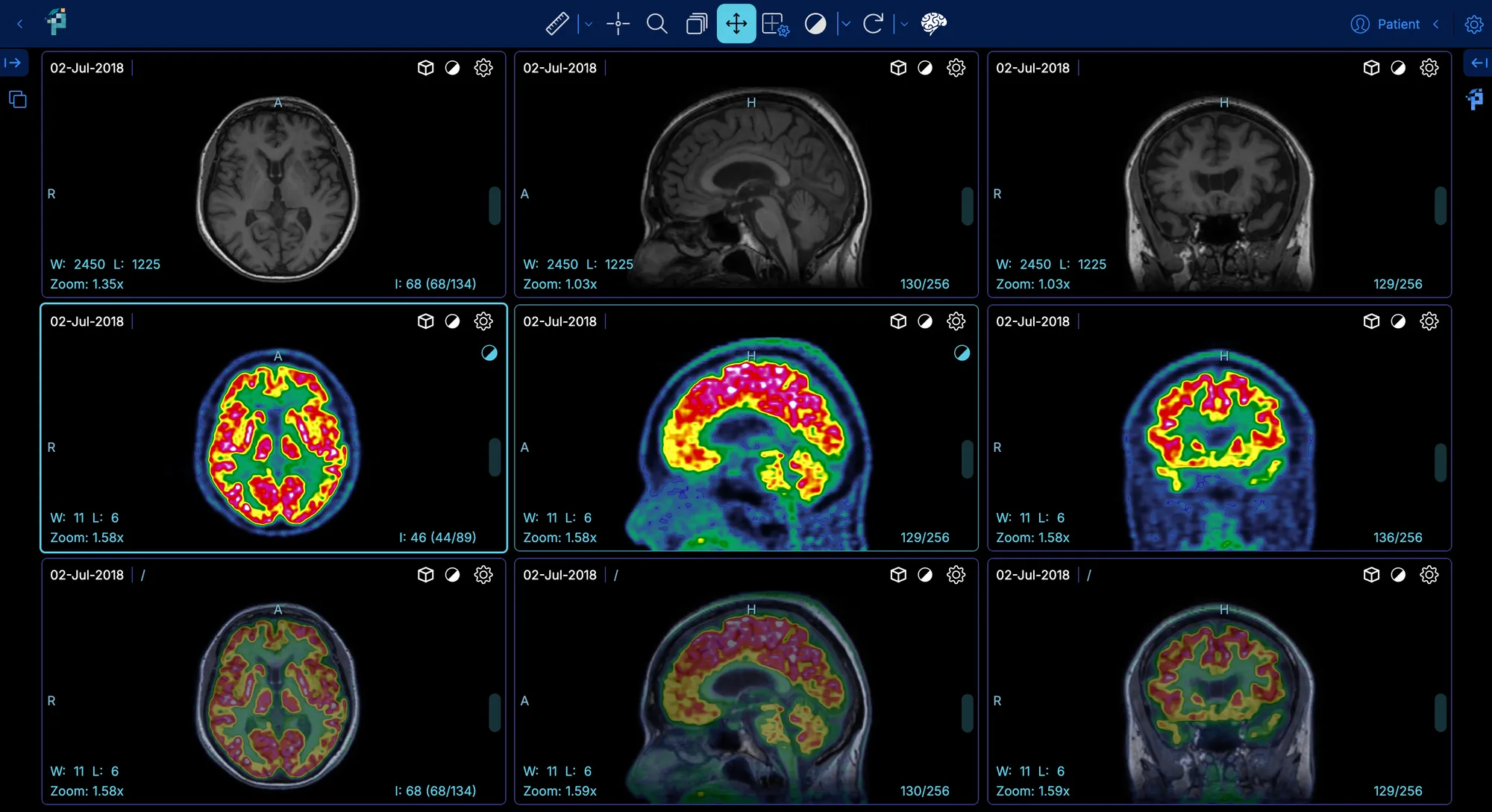 PET/CT quantification