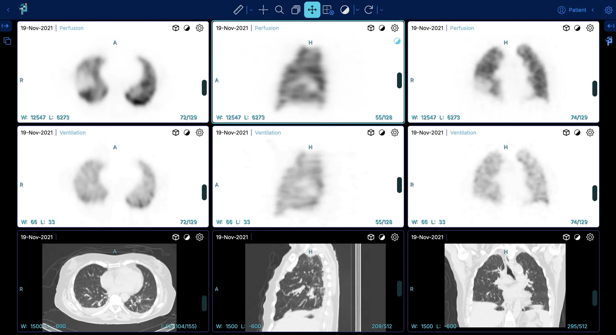 Lung scintigraphy