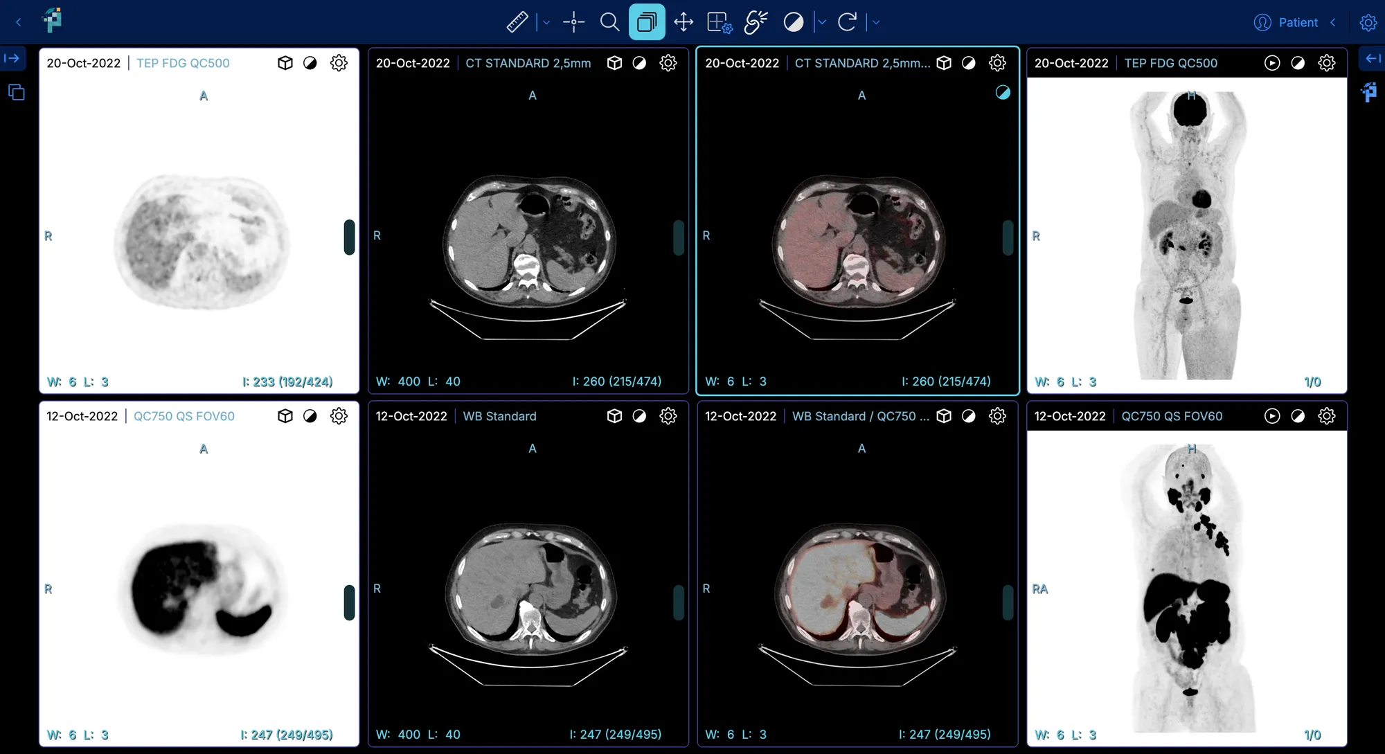 PET/CT case open in the PixiLearn imaging viewer: PET, CT, fusion and MIP views